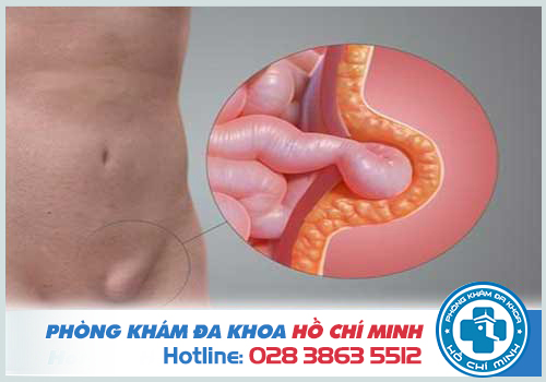 Sưng tinh hoàn do thoát vị bẹn