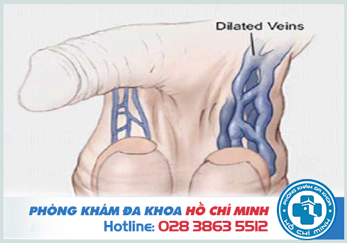 Giãn tĩnh mạch thừng tinh gây tinh hoàn 1 bên cao 1 bên thấp