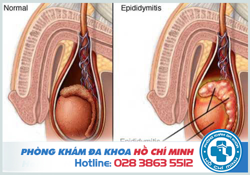 Tinh trùng màu nâu đỏ là bệnh gì? cách chữa trị