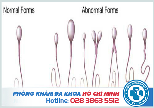 Cấu tạo tinh trùng bình thường và các dạng tinh trùng bất thường