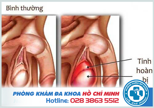 Tinh trùng vón cục trong suốt như thạch