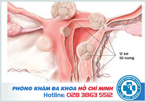 Chậm kinh có thể do bị mắc u xơ tử cung