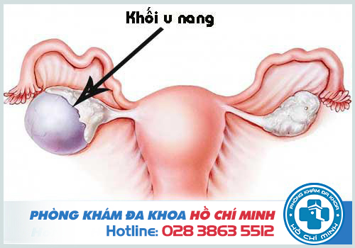 U nang buồng trứng kích thước bao nhiêu thì mổ