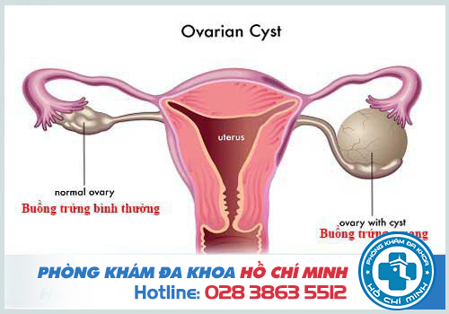U nang buồng trứng là bệnh ở mọi lứa tuổi sinh sản của nữ giới