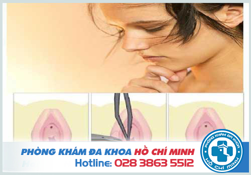 Vá màng trinh có bị phát hiện không