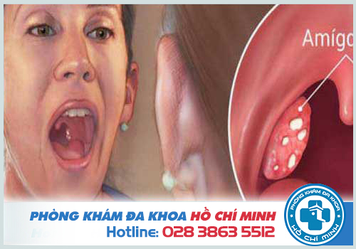 Viêm amidan hốc mủ uống thuốc gì tốt nhất