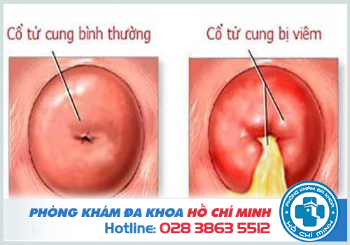 Viêm cổ tử cung đặt thuốc gì hay uống thuốc gì để chữa