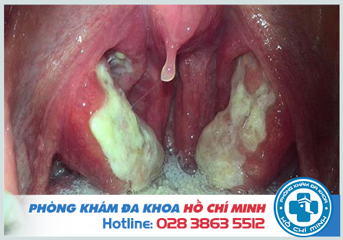 Viêm họng mủ có tự khỏi không?