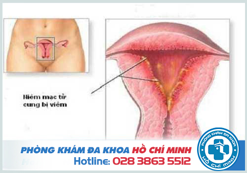 Viêm nhiễm phụ khoa ở tử cung