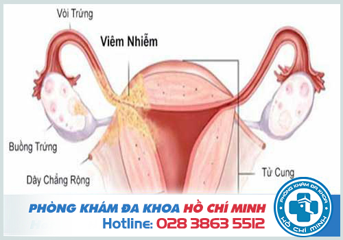 Viêm nhiễm phụ khoa ở phần phụ