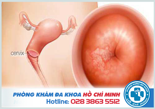 Viêm nhiễm phụ khoa ở cổ tử cung