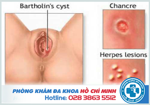 Viêm tuyến bartholin tái phát do nhiều nguyên nhân gây ra
