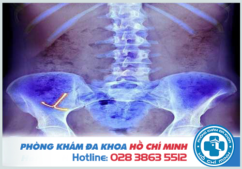 Sự cố khi đặt vòng tránh thai bị tụt thấp, bị lệch và bị đứt dây