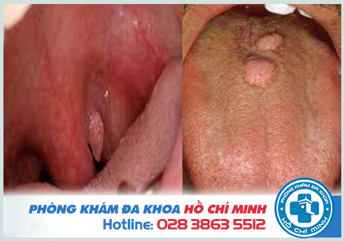 HPV là nguyên nhân hàng đầu gây ung thư ở khoang miệng rất nguy hiểm