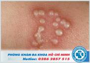 Bệnh mụn rộp sinh dục là gì? Nguyên nhân Dấu hiệu và Cách điều trị