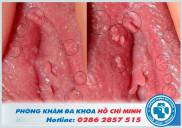 Chuỗi hạt ngọc âm vật ở nữ giới và thuốc điều trị